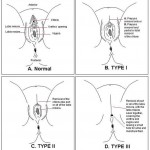 female-genital-mutilation1 http://myworld-nanamips.blogspot.com/2010/04/fgm-warning-explicit-graphic.html